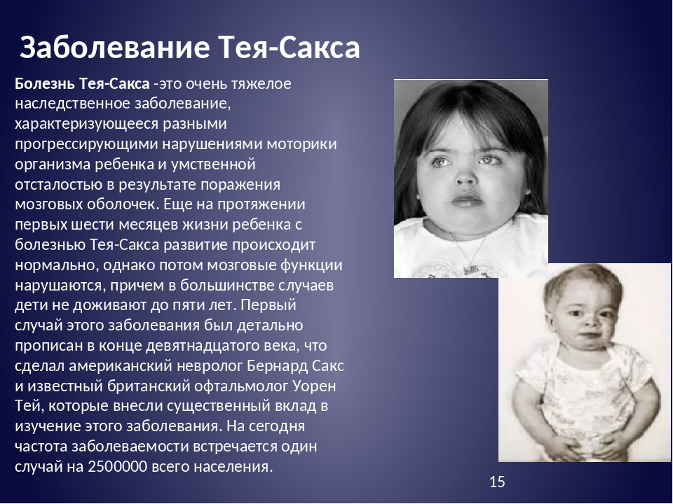 Презентация синдром тея сакса