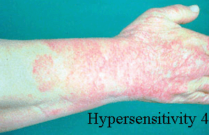 Hypersensitivity reaction type IV