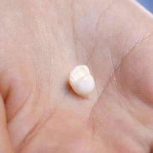 К чему снится выпадение зубов 