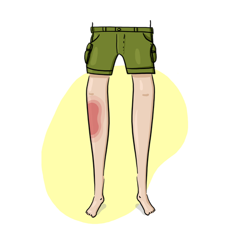 An illustration of legs with a bright red bruise on one of the legs.